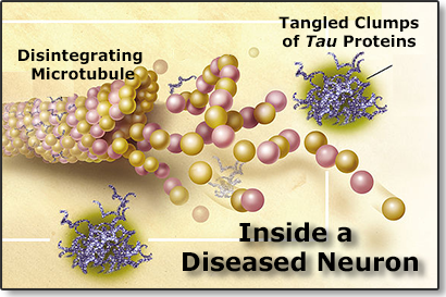 inside a diseased neuron