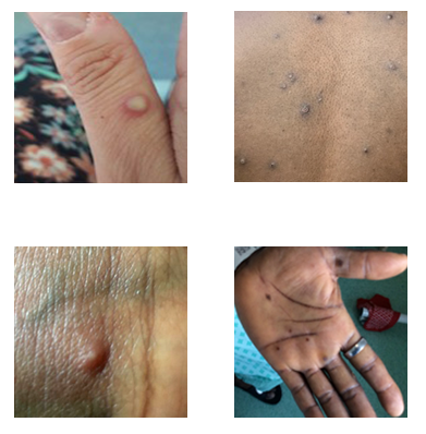 Examples of Monkeypox Rashes