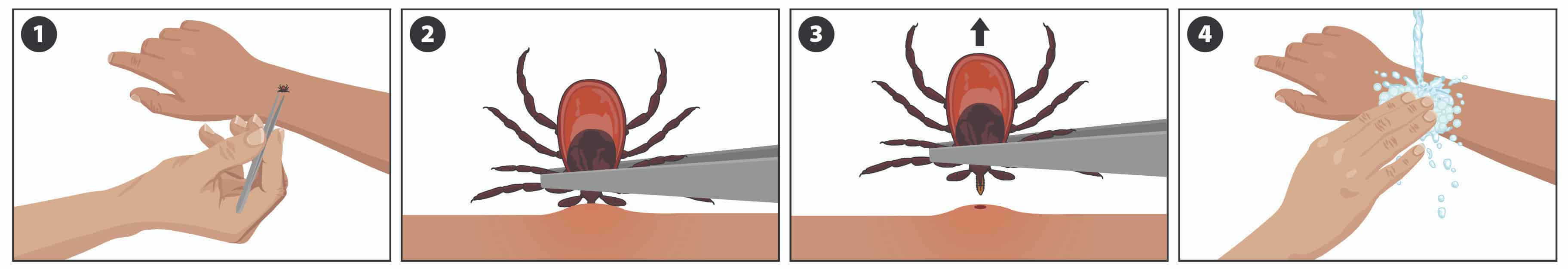 4 Steps to safe tick removal